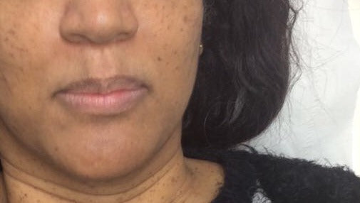 Before Seborrhoeic Wart Removal, Cheeks treatment at Laser Skin Clinics Wolverhampton