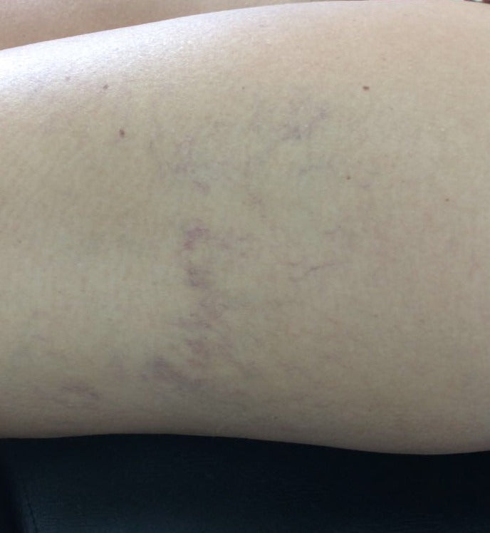 After Thread Vein Treatment, Thigh treatment at Laser Skin Clinics Wolverhampton