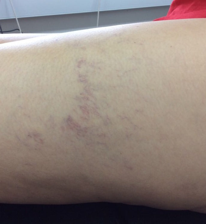 Before Thread Vein Treatment, Thigh treatment at Laser Skin Clinics Wolverhampton