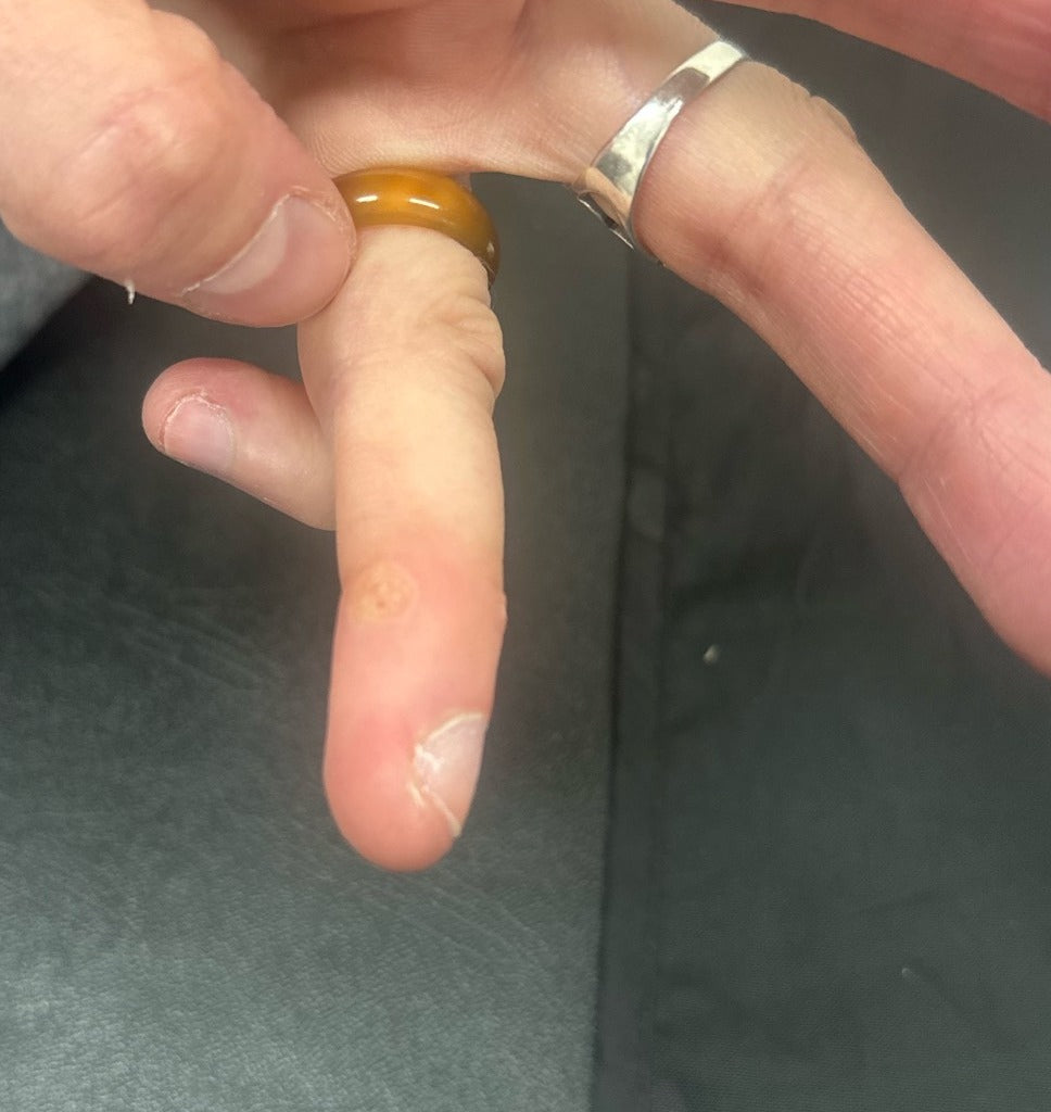 After Wart Removal treatment at Laser Skin Clinics Wolverhampton