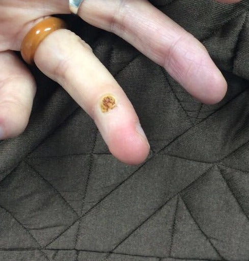 Before Wart Removal treatment at Laser Skin Clinics Wolverhampton